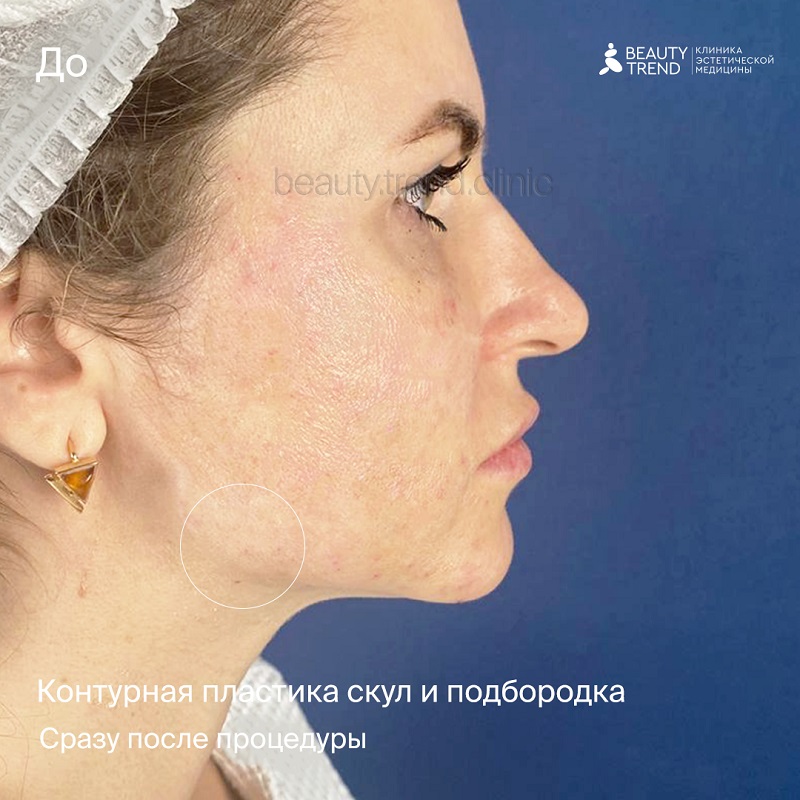 Контурная пластика, 11Г - до 1